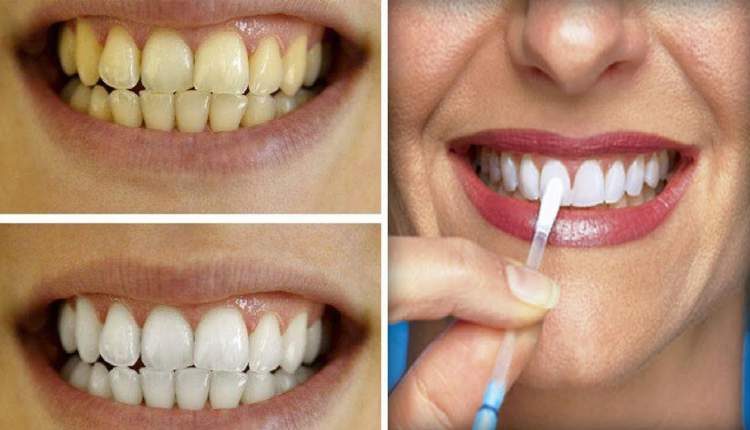 Tcnica caseira para clarear os dentes