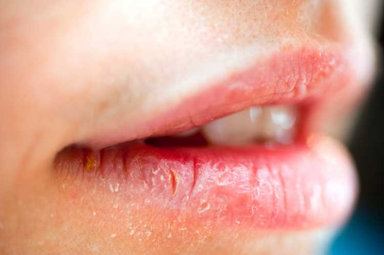 Confira o que a aparência dos lábios pode revelar a respeito da sua saúde