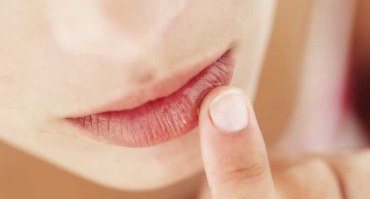 Lábios secos indicam problemas de saúde