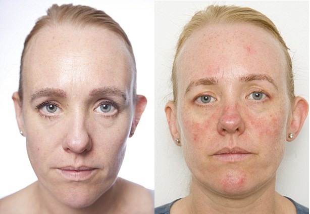 consequências de não retirar a maquiagem com demaquilante