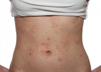 Tipos de alergias de pele
