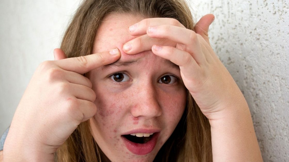 Óleo de jojoba no rosto para curar acne - [Foto: Canva]